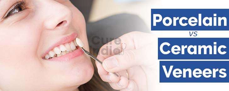 Dental Veneers